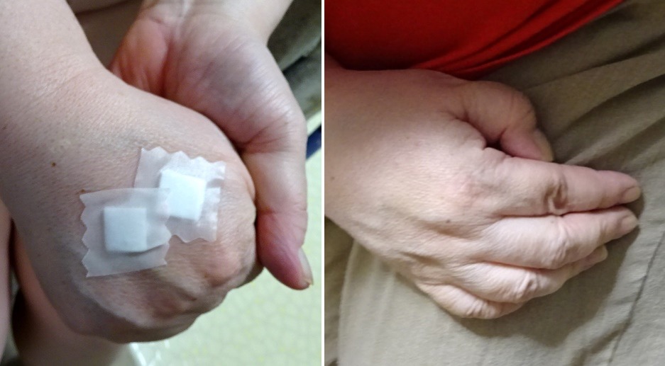 BTX注射によって指が伸び易くなる