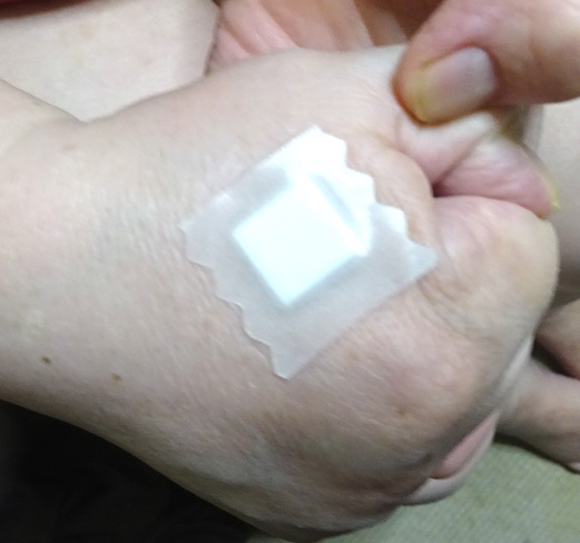 掌へのBTX注射は2箇所(絆創膏は1枚だが)