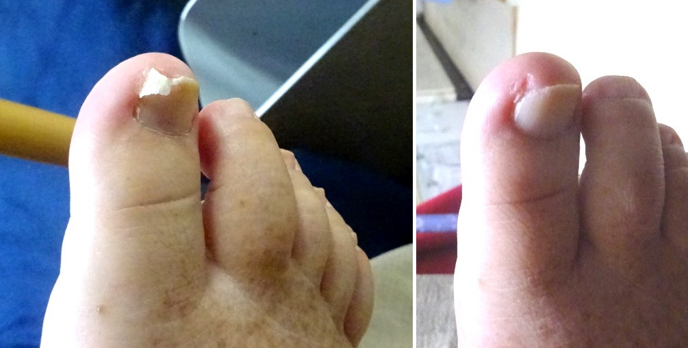 右足親指の爪の先(左側)が割れたのでその部分をカット