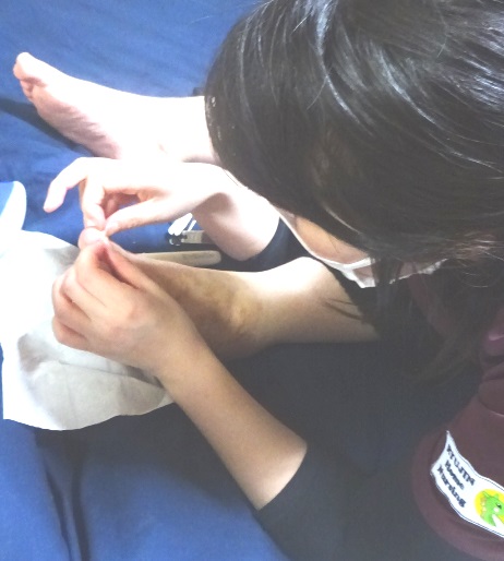 看護師さんによる巻き爪対応